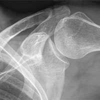 Shoulder Injury X-Ray